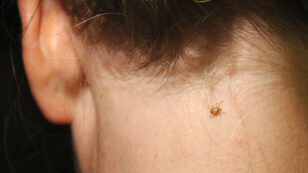 Ticks Spread Plenty More for You to Worry About Beyond Lyme Disease